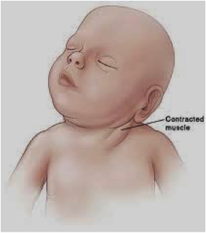 Torticollis 