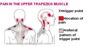 Myofascial Dysfunction