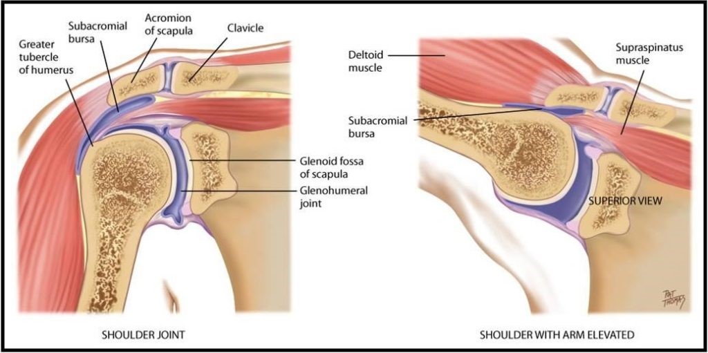 shoulder impingement