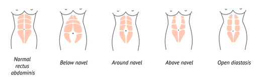 diastasis recti
